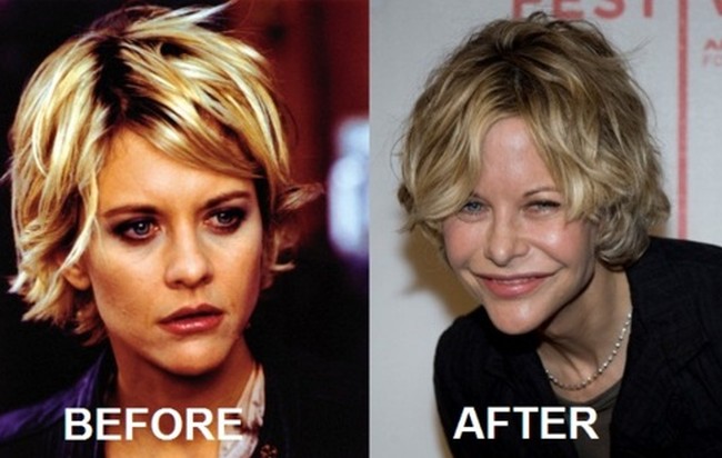 Meg-Ryan-Before-And-After-Eye-Surgery