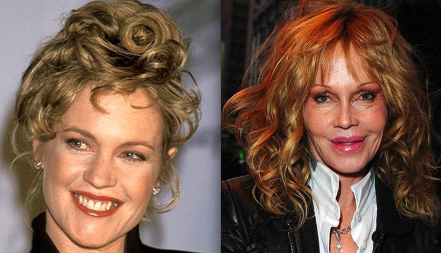 Melanie-Griffith-before-and-after-plastic-surgery-05